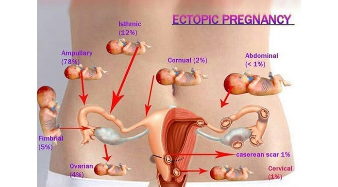 Higher Risk of Ectopic Pregnancy