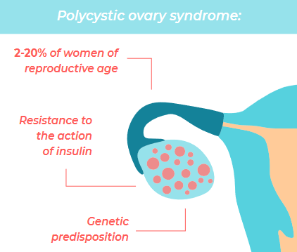 Polycystic ovary syndrome (PCOS)